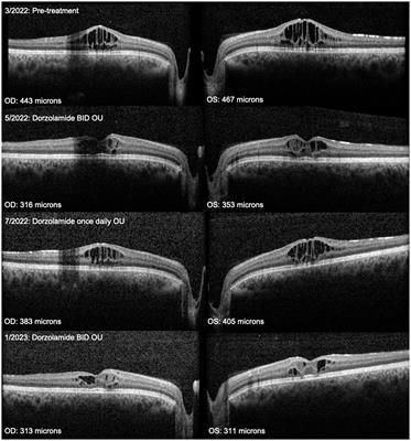 Carbonic anhydrase inhibitors limit complications in X-linked retinoschisis